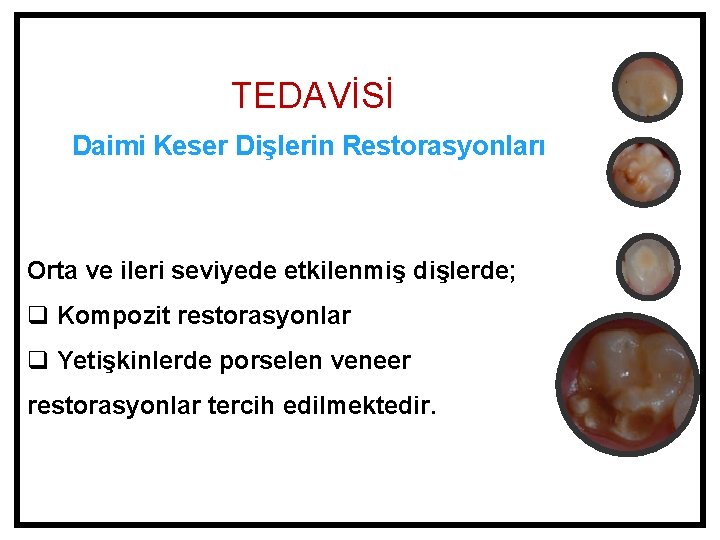 TEDAVİSİ Daimi Keser Dişlerin Restorasyonları Orta ve ileri seviyede etkilenmiş dişlerde; q Kompozit restorasyonlar