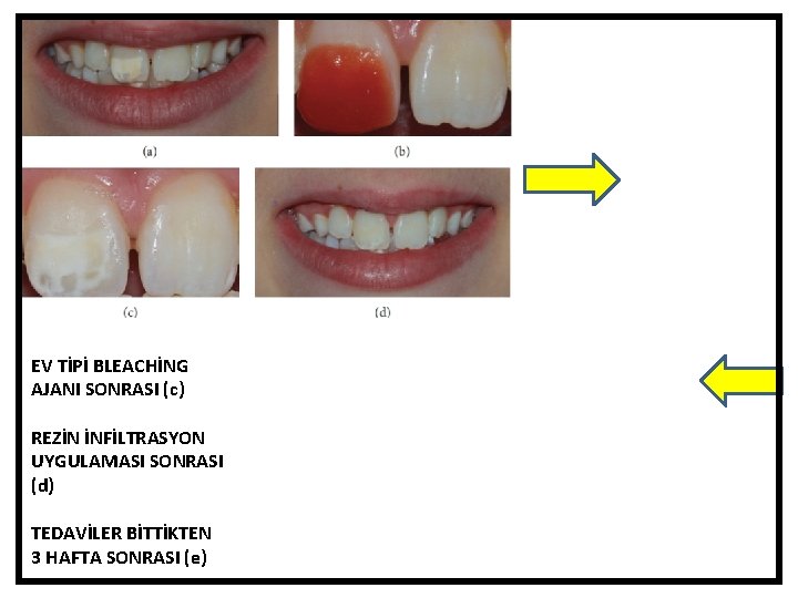 EV TİPİ BLEACHİNG AJANI SONRASI (c) REZİN İNFİLTRASYON UYGULAMASI SONRASI (d) TEDAVİLER BİTTİKTEN 3