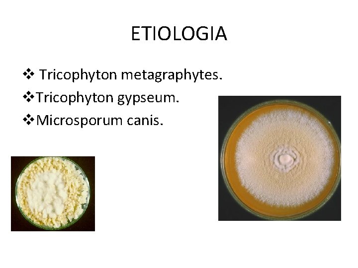 ETIOLOGIA v Tricophyton metagraphytes. v. Tricophyton gypseum. v. Microsporum canis. 