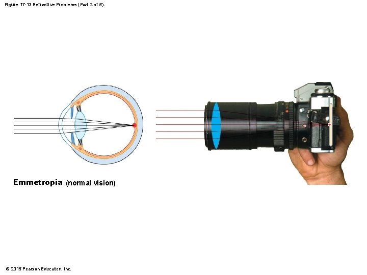 Figure 17 -13 Refractive Problems (Part 2 of 5). Emmetropia (normal vision) © 2015 Figure 17 -13 Refractive Problems (Part 2 of 5). Emmetropia (normal vision) © 2015