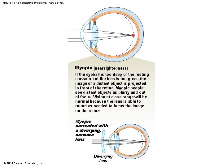 Figure 17 -13 Refractive Problems (Part 3 of 5). Myopia (nearsightedness) If the eyeball Figure 17 -13 Refractive Problems (Part 3 of 5). Myopia (nearsightedness) If the eyeball