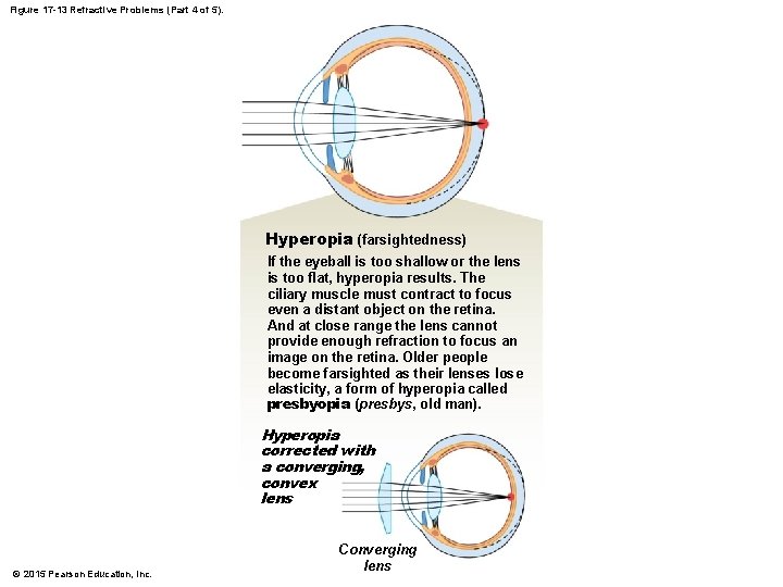 Figure 17 -13 Refractive Problems (Part 4 of 5). Hyperopia (farsightedness) If the eyeball Figure 17 -13 Refractive Problems (Part 4 of 5). Hyperopia (farsightedness) If the eyeball