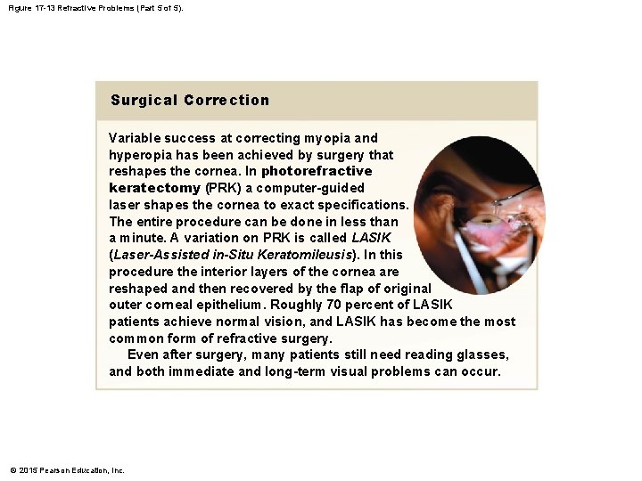 Figure 17 -13 Refractive Problems (Part 5 of 5). Surgical Correction Variable success at Figure 17 -13 Refractive Problems (Part 5 of 5). Surgical Correction Variable success at