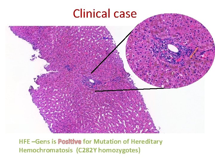 Clinical case HFE –Gens is Positive for Mutation of Hereditary Hemochromatosis (C 282 Y
