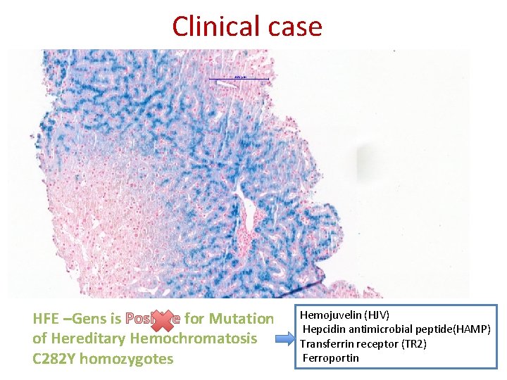 Clinical case HFE –Gens is Positive for Mutation of Hereditary Hemochromatosis C 282 Y