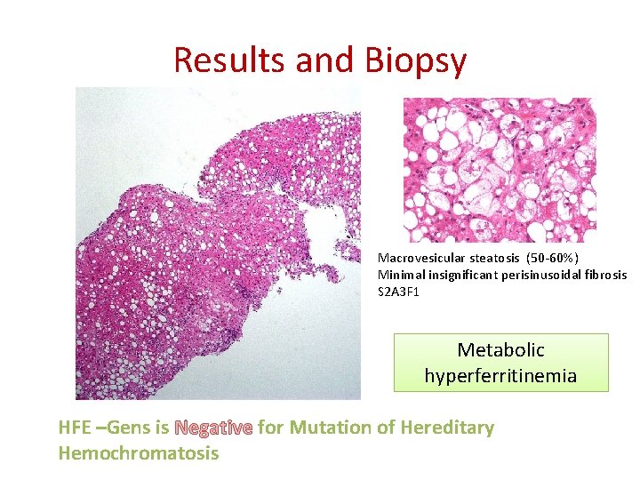 Results and Biopsy Macrovesicular steatosis (50 -60%) Minimal insignificant perisinusoidal fibrosis S 2 A