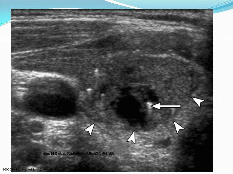 Punctate echogenicities in thyroid nodules. Frates M C et al. Radiology 2005; 237: 794