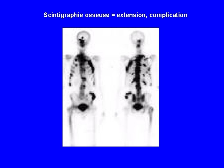 Scintigraphie osseuse = extension, complication 