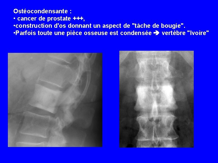 Ostéocondensante : • cancer de prostate +++, • construction d'os donnant un aspect de