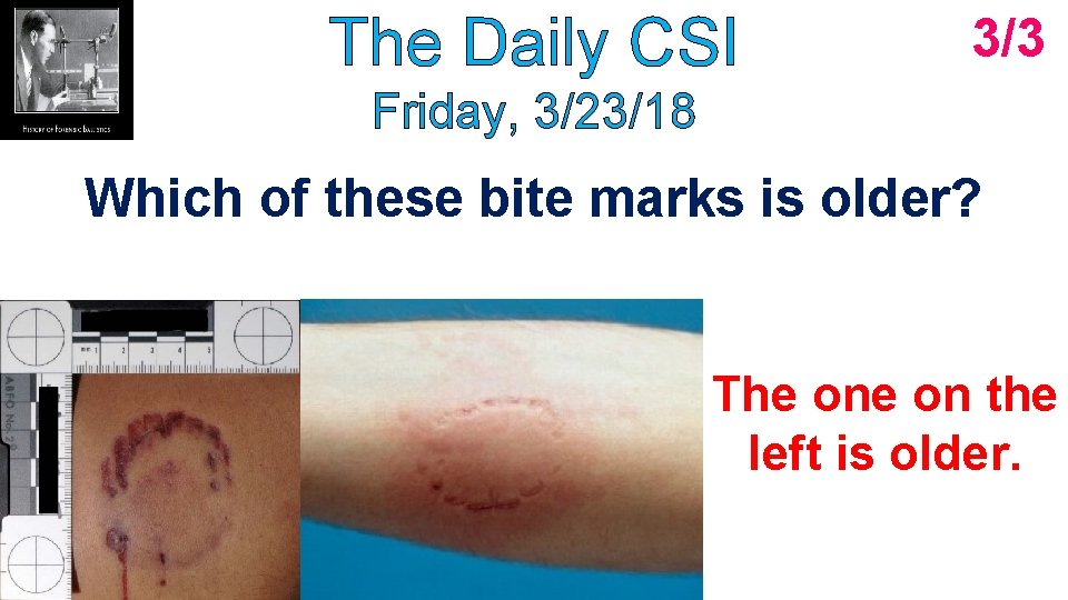 The Daily CSI 3/3 Friday, 3/23/18 Which of these bite marks is older? The