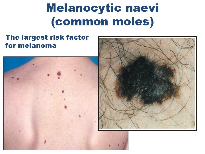 Melanocytic naevi (common moles) The largest risk factor for melanoma 
