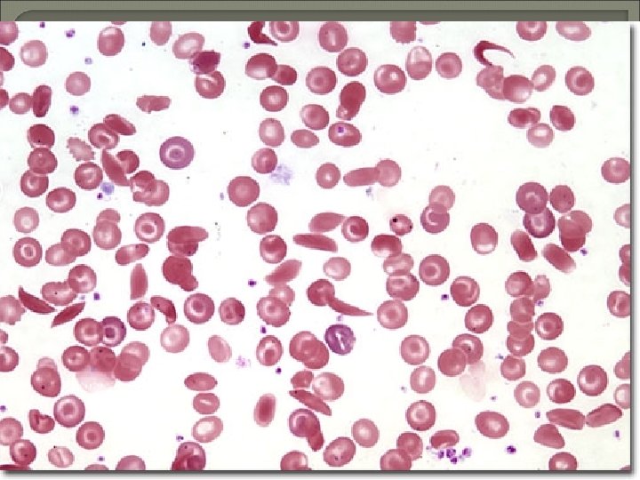 Sickle Cell Disease 