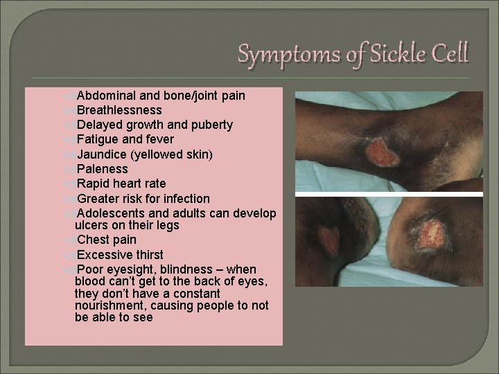 Symptoms of Sickle Cell Abdominal and bone/joint pain Breathlessness Delayed growth and puberty Fatigue