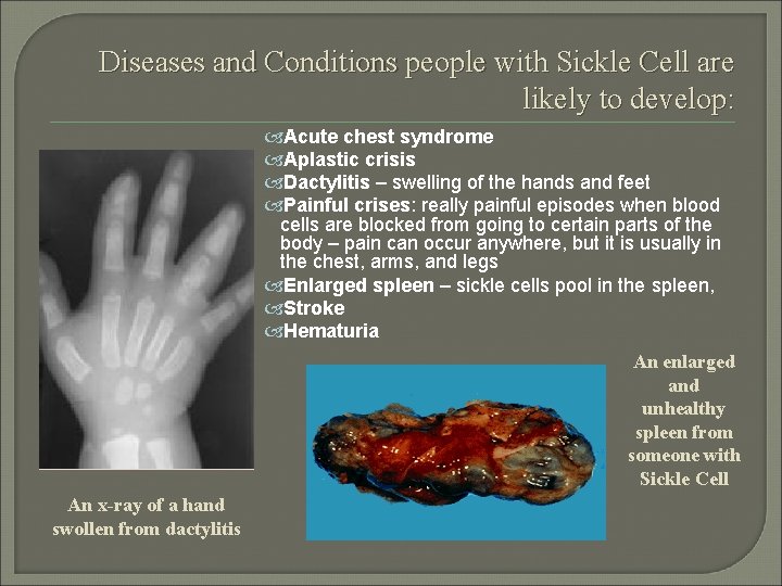 Diseases and Conditions people with Sickle Cell are likely to develop: Acute chest syndrome