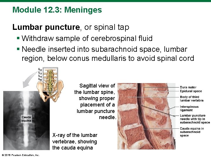 Module 12. 3: Meninges Lumbar puncture, or spinal tap § Withdraw sample of cerebrospinal