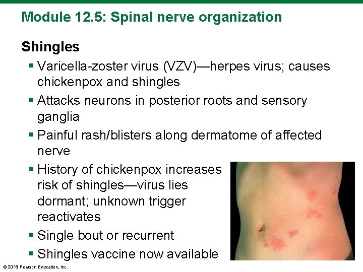 Module 12. 5: Spinal nerve organization Shingles § Varicella-zoster virus (VZV)—herpes virus; causes chickenpox