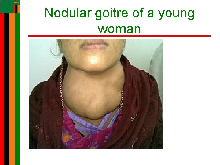Nodular goitre of a young woman Nodular goitre of a young woman