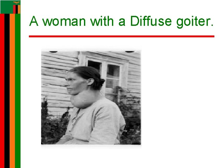 A woman with a Diffuse goiter. A woman with a Diffuse goiter.