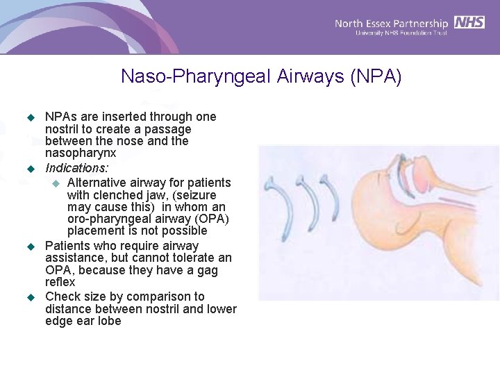 Naso-Pharyngeal Airways (NPA) u u NPAs are inserted through one nostril to create a