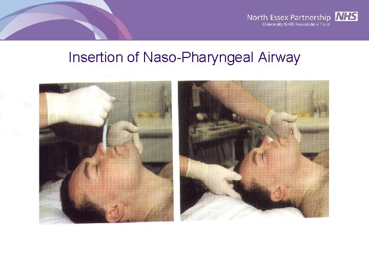 Insertion of Naso-Pharyngeal Airway 