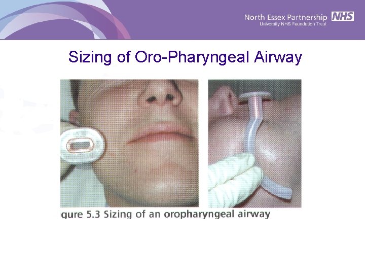 Sizing of Oro-Pharyngeal Airway 