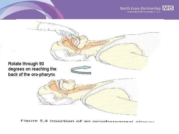 Insertion of OPA Rotate through 90 degrees on reaching the back of the oro-pharynx