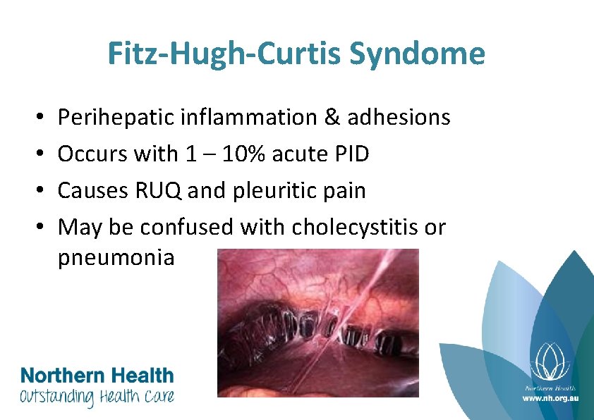 Fitz-Hugh-Curtis Syndome • • Perihepatic inflammation & adhesions Occurs with 1 – 10% acute