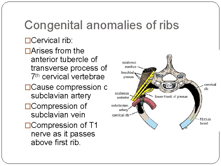 Congenital anomalies of ribs �Cervical rib: �Arises from the anterior tubercle of transverse process