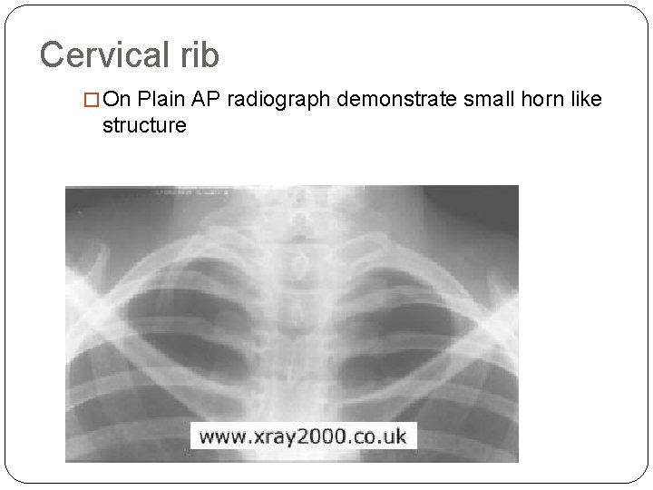 Cervical rib � On Plain AP radiograph demonstrate small horn like structure 