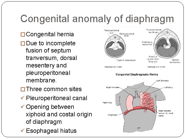 Congenital anomaly of diaphragm � Congenital hernia � Due to incomplete fusion of septum