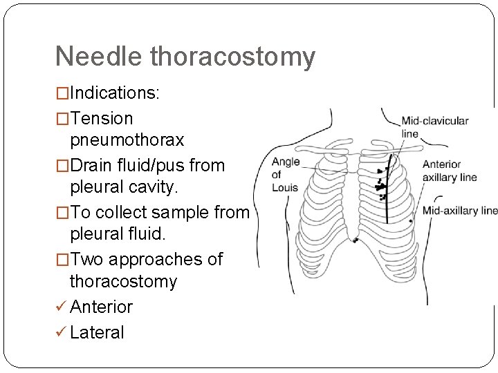 Needle thoracostomy �Indications: �Tension pneumothorax �Drain fluid/pus from pleural cavity. �To collect sample from