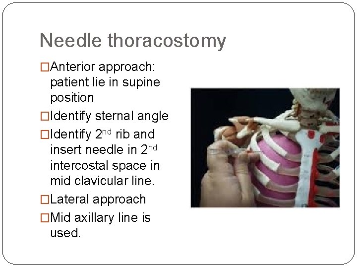 Needle thoracostomy �Anterior approach: patient lie in supine position �Identify sternal angle �Identify 2