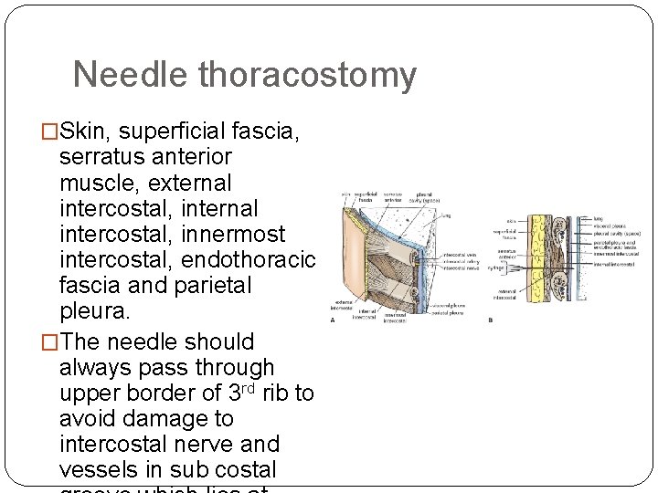 Needle thoracostomy �Skin, superficial fascia, serratus anterior muscle, external intercostal, innermost intercostal, endothoracic fascia
