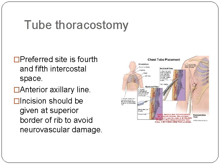 Tube thoracostomy �Preferred site is fourth and fifth intercostal space. �Anterior axillary line. �Incision