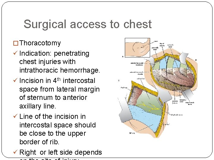 Surgical access to chest � Thoracotomy ü Indication: penetrating chest injuries with intrathoracic hemorrhage.