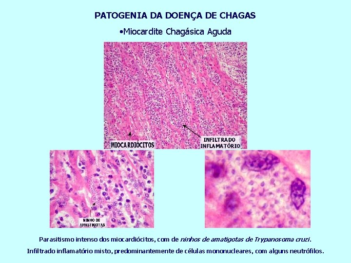 PATOGENIA DA DOENÇA DE CHAGAS • Miocardite Chagásica Aguda Parasitismo intenso dos miocardiócitos, com