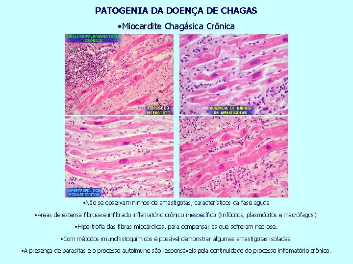 PATOGENIA DA DOENÇA DE CHAGAS • Miocardite Chagásica Crônica • Não se observam ninhos