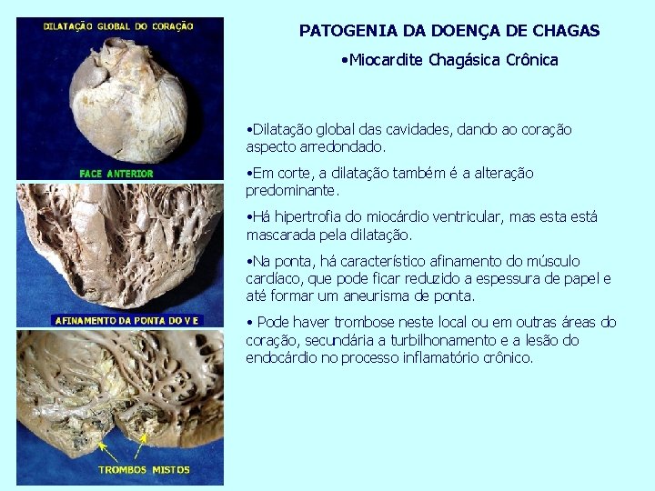PATOGENIA DA DOENÇA DE CHAGAS • Miocardite Chagásica Crônica • Dilatação global das cavidades,