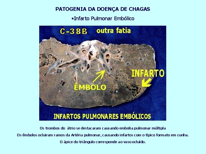 PATOGENIA DA DOENÇA DE CHAGAS • Infarto Pulmonar Embólico Os trombos do átrio se