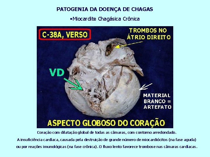 PATOGENIA DA DOENÇA DE CHAGAS • Miocardite Chagásica Crônica Coração com dilatação global de