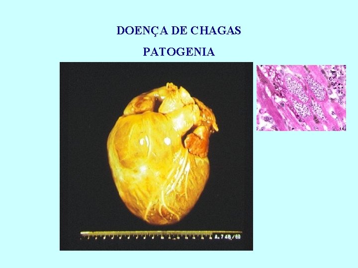 DOENÇA DE CHAGAS PATOGENIA 