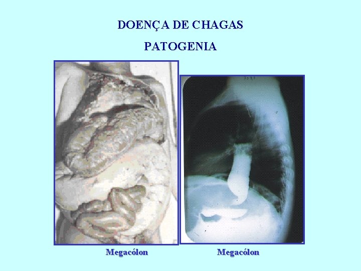 DOENÇA DE CHAGAS PATOGENIA Megacólon 