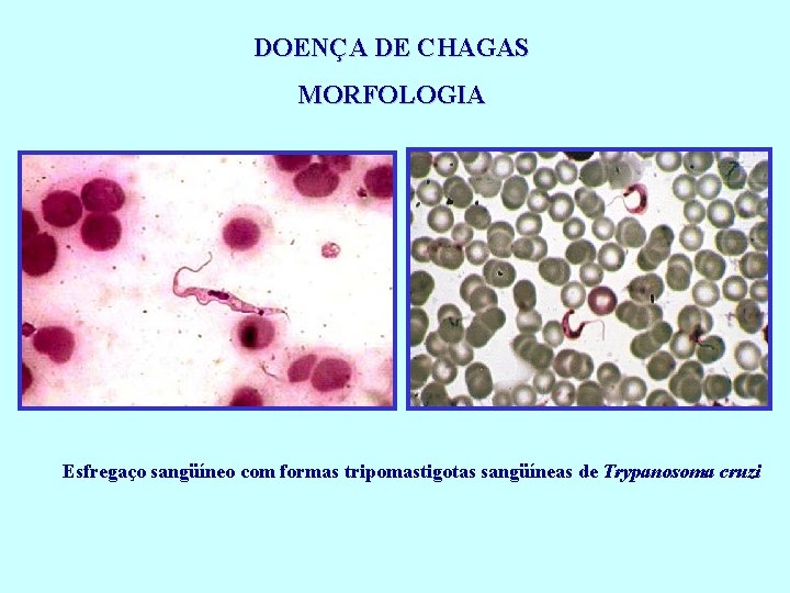 DOENÇA DE CHAGAS MORFOLOGIA Esfregaço sangüíneo com formas tripomastigotas sangüíneas de Trypanosoma cruzi 