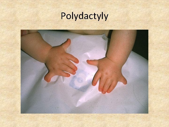 Polydactyly 