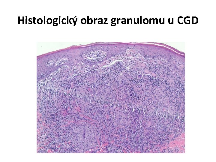 Histologický obraz granulomu u CGD 