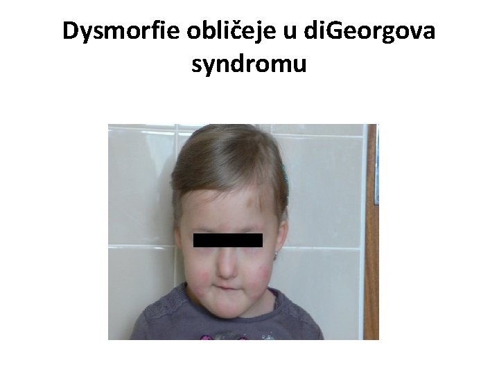 Dysmorfie obličeje u di. Georgova syndromu 