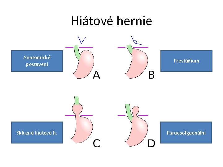 Hiátové hernie Anatomické postavení Prestádium Skluzná hiatová h. Paraesofgaenální 