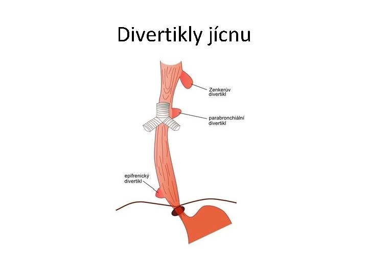 Divertikly jícnu 