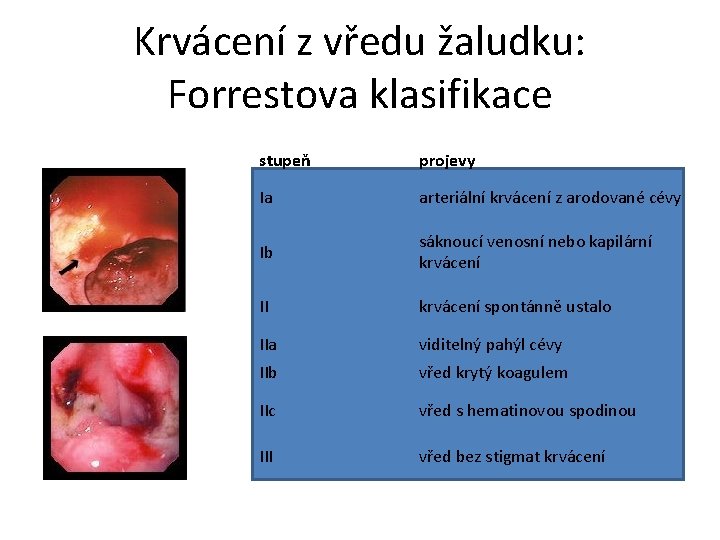 Krvácení z vředu žaludku: Forrestova klasifikace stupeň projevy Ia arteriální krvácení z arodované cévy