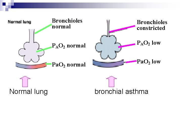 Normal lung Bronchioles normal Bronchioles constricted PAO 2 normal PAO 2 low Pa. O